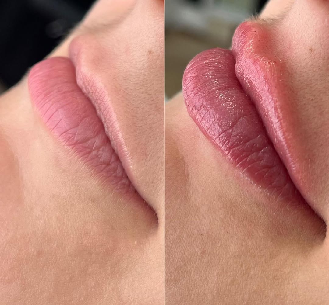 Preenchimento labial 