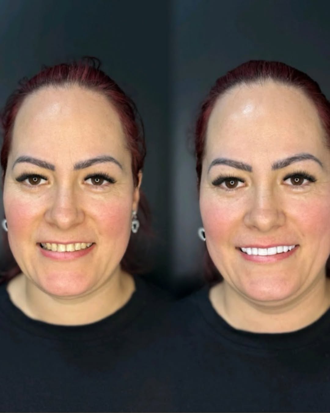 Facetas de resina