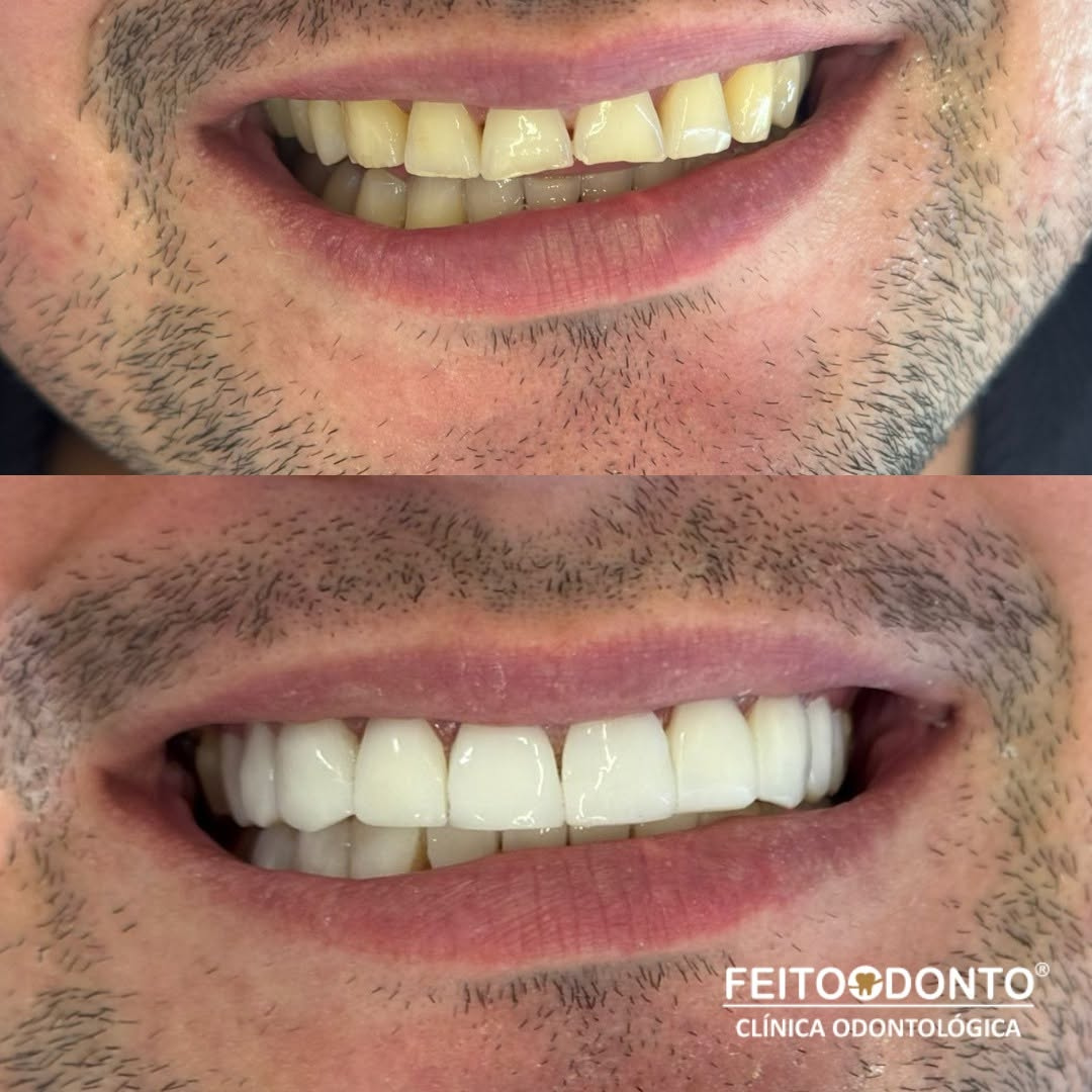 Transformamos sorrisos em verdadeiras obras de arte com nossas Facetas em Resina. 