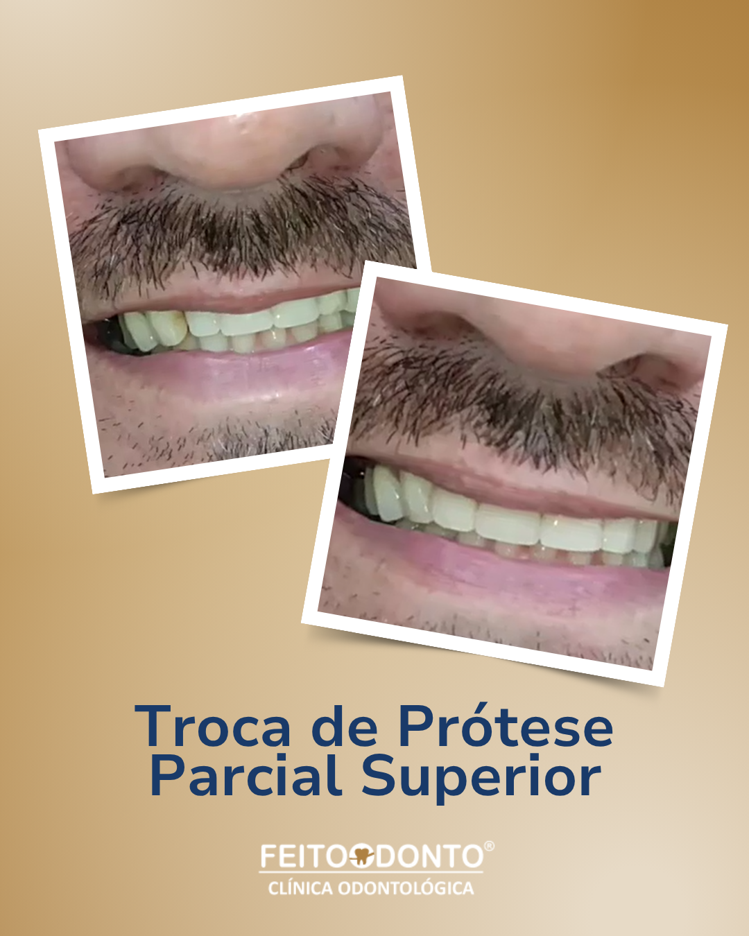 Troca de prótese parcial superior